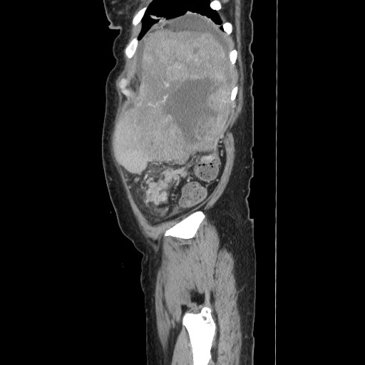 Acinar cell carcinoma of the pancreas (Radiopaedia 75442-86669 Sagittal C+ portal venous phase 165).jpg
