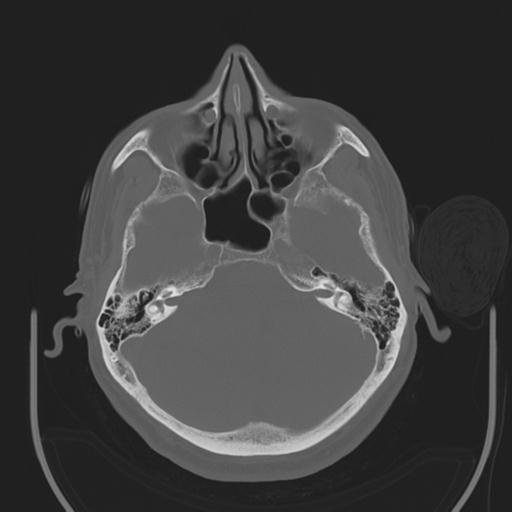 File:Acoustic schwannoma (Radiopaedia 29488-29982 AXIAL BONE THICK non-contrast 13).jpg