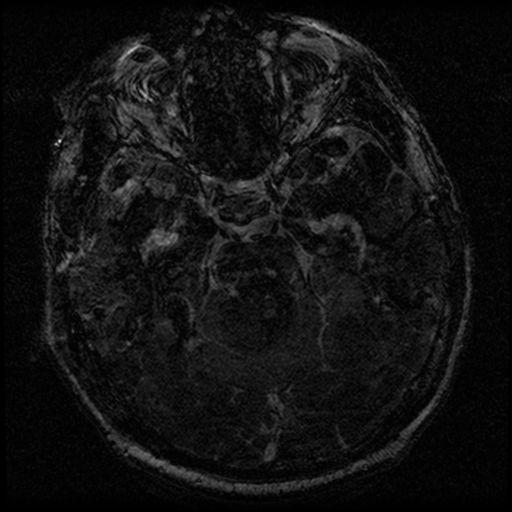 File:Acoustic schwannoma (Radiopaedia 39170-41387 Axial FIESTA 111).png
