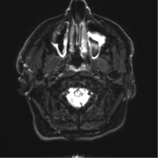 Acoustic schwannoma (Radiopaedia 50846-56358 Axial DWI 1).png