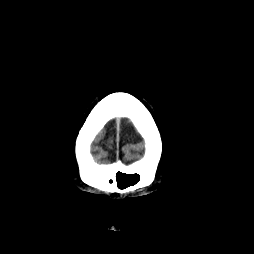 File:Acoustic schwannoma (Radiopaedia 55729-62280 Coronal non-contrast 4).png