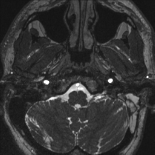 Acoustic schwannoma (translabyrinthine resection) (Radiopaedia 43570-46972 Axial CISS 10).png