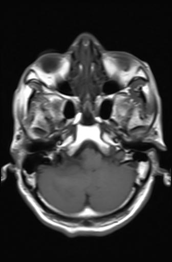 File:Acoustic schwannoma - probable (Radiopaedia 20386-20292 Axial T1 4).jpg