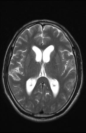 File:Acoustic schwannoma - probable (Radiopaedia 20386-20292 Axial T2 11).jpg