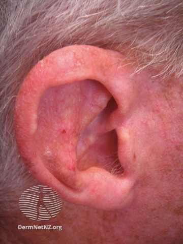 Actinic Keratoses affecting the face (DermNet NZ lesions-ak-face-300).jpg