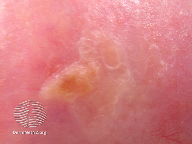 Actinic Keratoses affecting the face (DermNet NZ lesions-ak-face-540).jpg