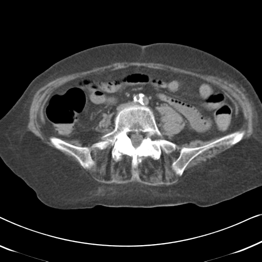 File:Active bleeding from duodenal ulcer with embolization (Radiopaedia 34216-35481 Axial non-contrast 40).png