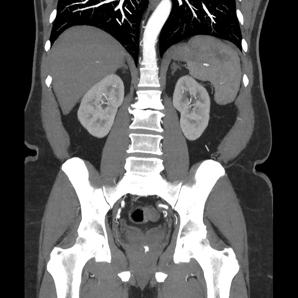 Active colonic bleed on CT (Radiopaedia 49765-55025 Coronal art MIP 41).jpg