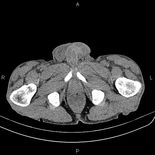 Active crohn disease (Radiopaedia 87133-103397 Axial non-contrast 107).jpg