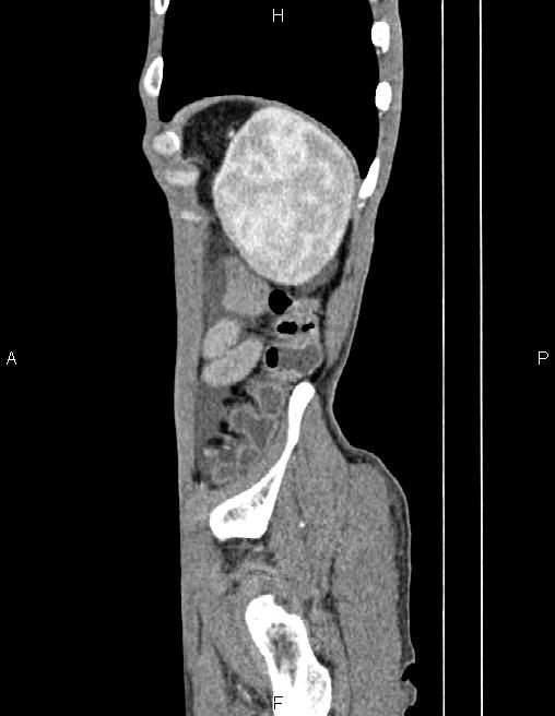 Active crohn disease (Radiopaedia 87133-103397 Sagittal C+ arterial phase 80).jpg