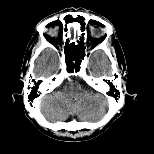File:Active neurocysticercosis before and after therapy (Radiopaedia 71710-82099 Axial C+ delayed 81).jpg