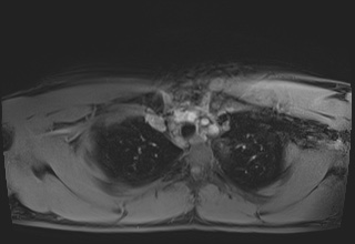 Active right ventricular cardiac sarcoidosis (Radiopaedia 55596-62100 Axial Post contrast Dixon 5).jpg