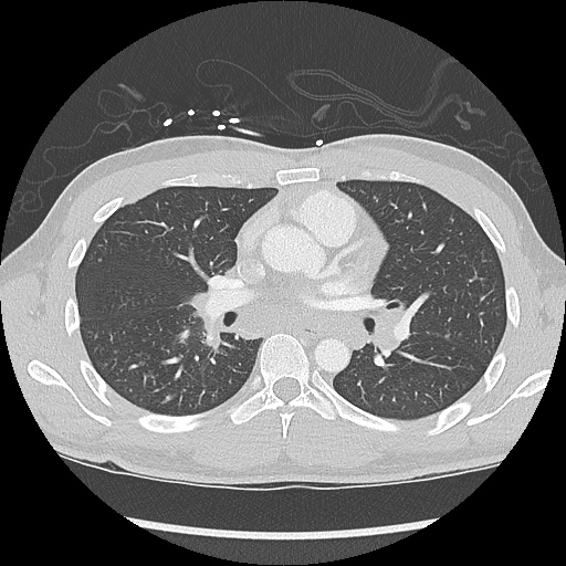 File:Active right ventricular cardiac sarcoidosis (Radiopaedia 55596-62101 Axial lung window 21).jpg