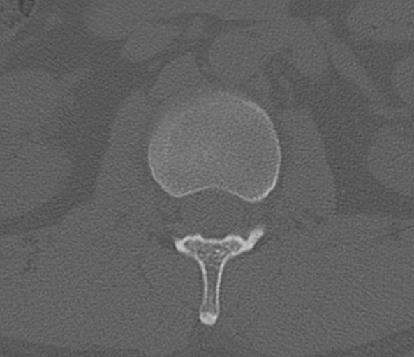 File:Acute L1 burst compression fracture (Radiopaedia 34430-35755 Axial bone window 26).png