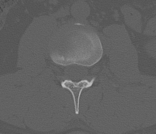 File:Acute L1 burst compression fracture (Radiopaedia 34430-35755 Axial bone window 39).png