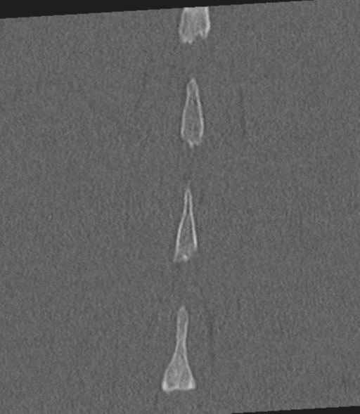 Acute L1 burst compression fracture (Radiopaedia 34430-35755 Coronal bone window 58).png