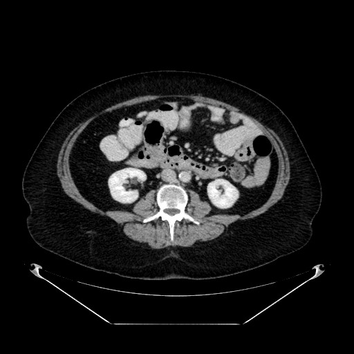 Acute appendicitis, heterotaxy syndrome (Radiopaedia 66884-76202 Axial C+ portal venous phase 65).jpg