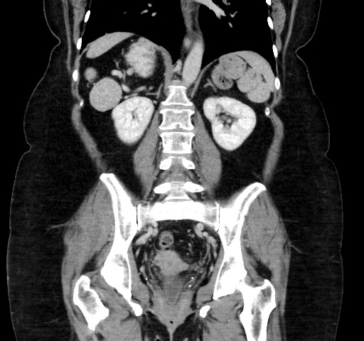 Acute appendicitis, heterotaxy syndrome (Radiopaedia 66884-76202 Coronal C+ portal venous phase 81).jpg