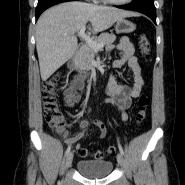 Acute appendicitis (Radiopaedia 38255-40270 Coronal C+ portal venous phase 38).jpg