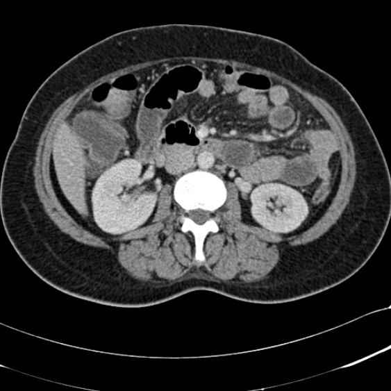 File:Acute appendicitis (Radiopaedia 48792-53822 Axial C+ portal venous phase 51).jpg