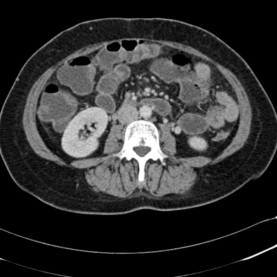 Acute appendicitis (Radiopaedia 48792-53822 Axial C+ portal venous phase 59).jpg