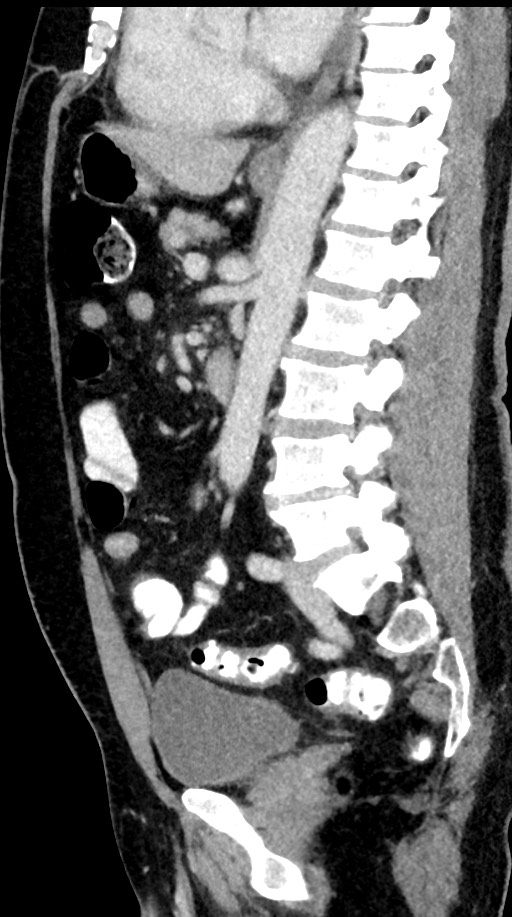 Acute appendicitis (Radiopaedia 77016-88960 Sagittal C+ portal venous phase 52).jpg