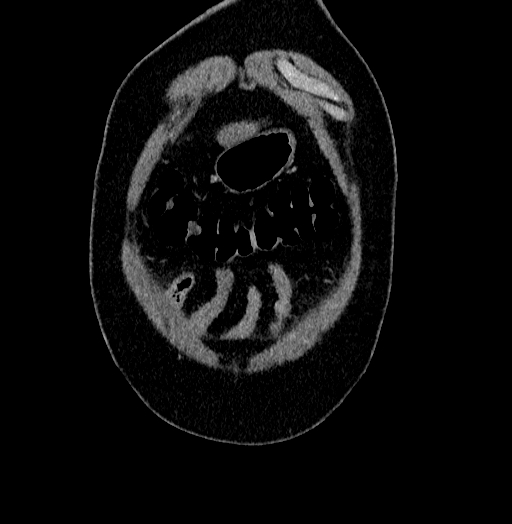 File:Acute appendicitis (Radiopaedia 79950-93224 Coronal C+ portal venous phase 4).jpg