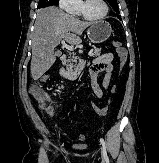 Acute appendicitis (Radiopaedia 79950-93224 Coronal C+ portal venous phase 40).jpg