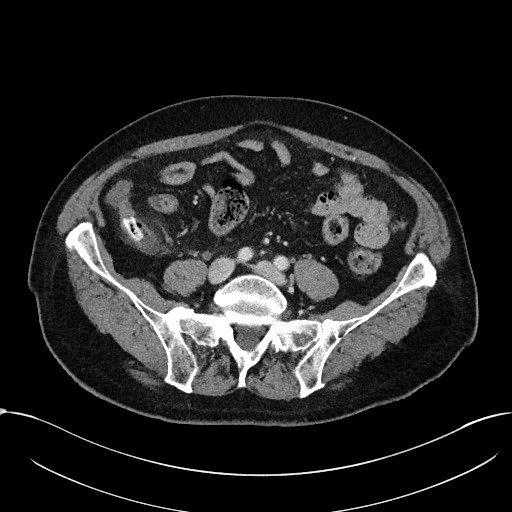 File:Acute appendicitis - large appendicoliths (Radiopaedia 61805-69820 Axial 18).jpg