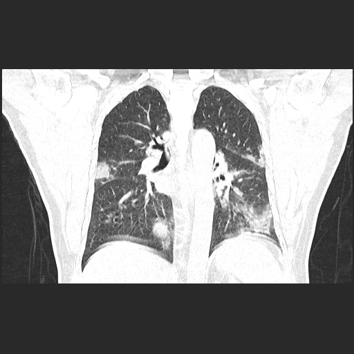 File:Acute appendicitis and COVID 19 pneumonia (Radiopaedia 76604-88380 G 40).jpg