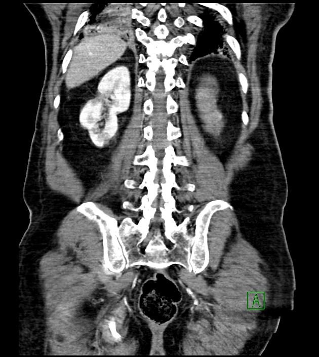 Acute arterial mesenteric ischemia (Radiopaedia 78238-90828 Coronal C+ portal venous phase 71).jpg