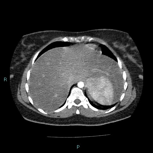 File:Acute bilateral pyelonephritis (Radiopaedia 37146-38881 Axial C+ arterial phase 17).jpg