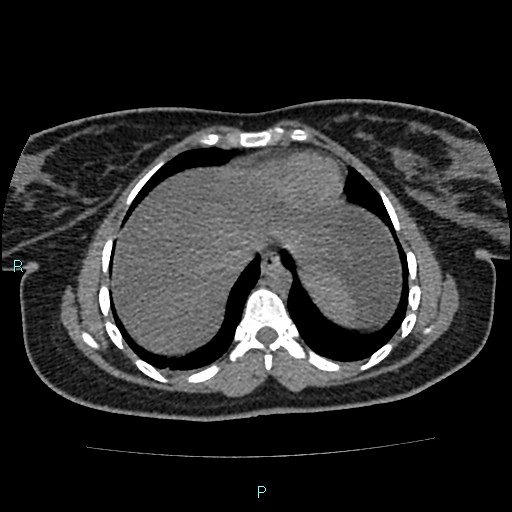 Acute bilateral pyelonephritis (Radiopaedia 37146-38881 Axial non-contrast 7).jpg