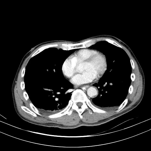 Acute bowel ischemia (Radiopaedia 87695-104114 Axial C+ portal venous phase 3).jpg