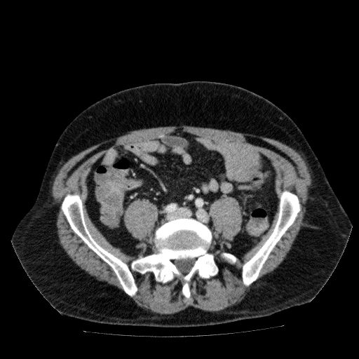 Acute cholecystitis and incidental left sided IVC (Radiopaedia 49352-54459 Axial C+ portal venous phase 105).jpg