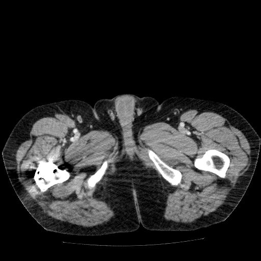 File:Acute cholecystitis and incidental left sided IVC (Radiopaedia 49352-54459 Axial C+ portal venous phase 173).jpg