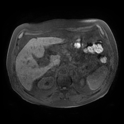 Acute cholecystitis complicated by pylephlebitis (Radiopaedia 65782-74915 Axial T1 fat sat 47).jpg