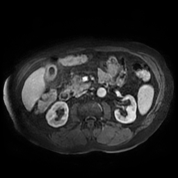 Acute cholecystitis complicated by pylephlebitis (Radiopaedia 65782-74915 Axial arterioportal phase T1 C+ fat sat 83).jpg