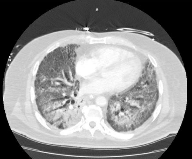 Acute cor pulmonale (ultrasound) (Radiopaedia 83508-98818 Axial lung window 55).jpg