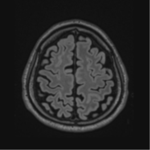 Acute disseminated encephalomyelitis (ADEM)- Anti-NMDA receptor encephalitis (Radiopaedia 54920-61201 Axial FLAIR 56).png