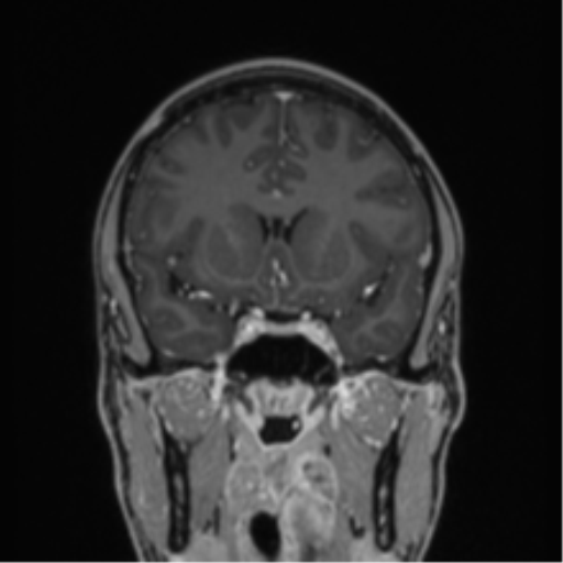 Acute disseminated encephalomyelitis (ADEM) (Radiopaedia 65319-74349 Coronal T1 C+ 35).png