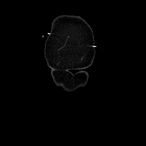 Acute diverticulitis - transverse colon (Radiopaedia 87063-103327 Coronal C+ portal venous phase 14).jpg