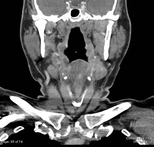 Acute epiglottitis (Radiopaedia 54375-60590 Coronal C+ arterial phase 35).jpg