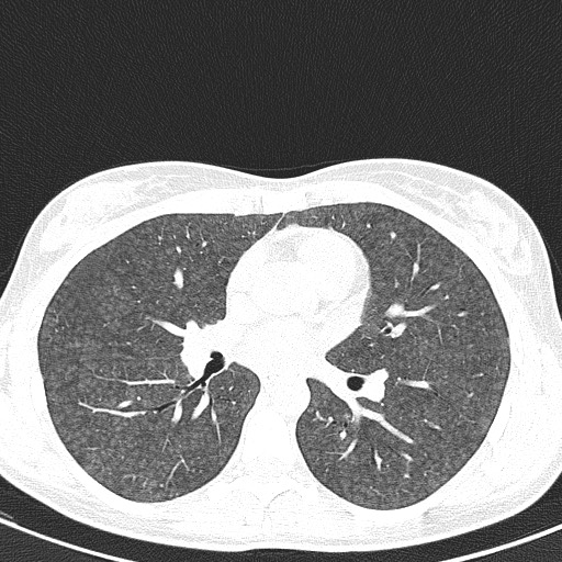 File:Acute hypersensitivity pneumonitis (Radiopaedia 85293-100870 Axial lung window 59).jpg