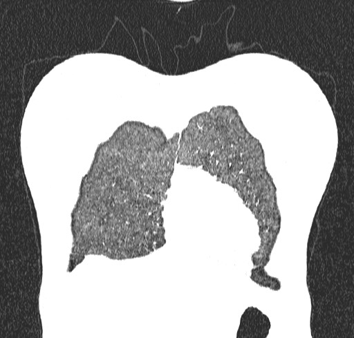 Acute hypersensitivity pneumonitis (Radiopaedia 85293-100870 Coronal lung window 9).jpg