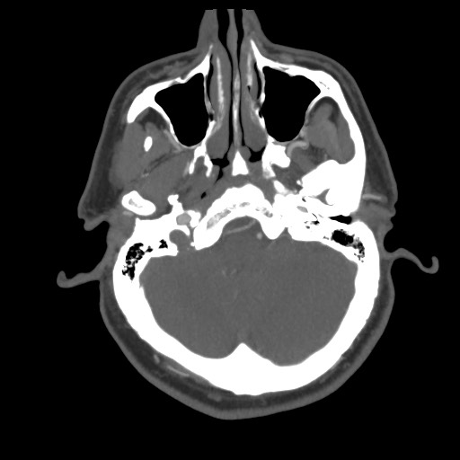 File:Acute internal carotid artery dissection (Radiopaedia 53541-59630 D 16).jpg