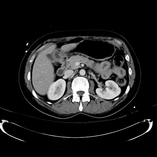 Acute myocardial infarction in CT (Radiopaedia 39947-42415 Axial C+ portal venous phase 47).jpg