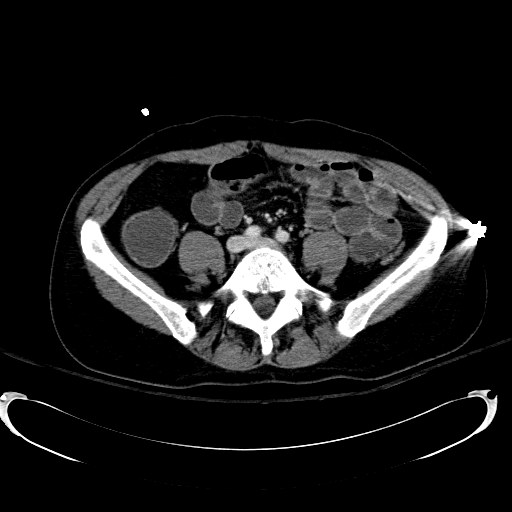 Acute myocardial infarction in CT (Radiopaedia 39947-42415 Axial C+ portal venous phase 86).jpg