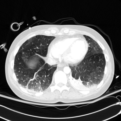 Acute myocardial infarction in CT (Radiopaedia 39947-42415 Axial lung window 101).jpg