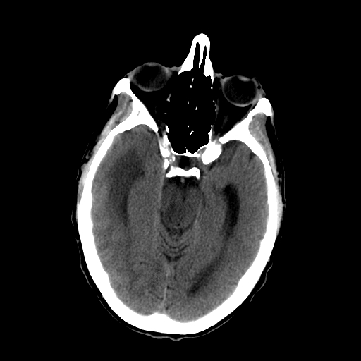 File:Acute necrotizing toxoplasma encephalitis (Radiopaedia 10683-11150 Axial non-contrast 22).jpg